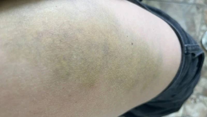 Таких синяков у меня не было: вторая жительница Южно-Сахалинска пострадала в салоне автобуса